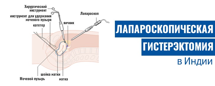 Лапароскопическая гистерэктомия в Индии